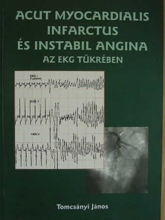 Tomcsányi János - Acut myocardialis infarctus és instabil angina az EKG tükrében [antikvár]