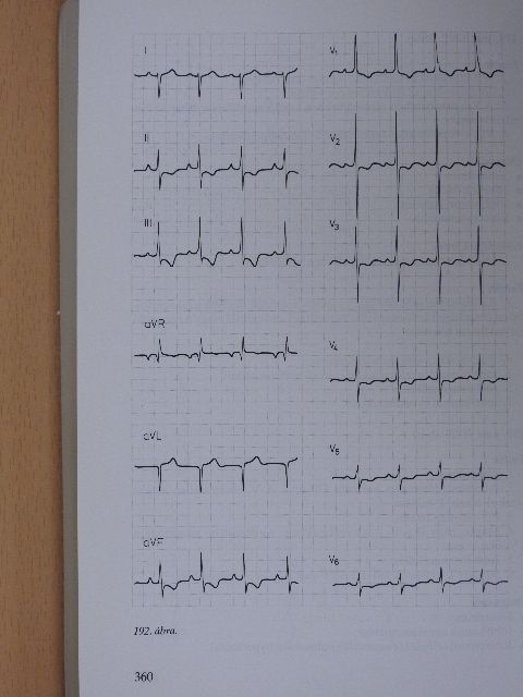 Kékes Ede - EKG atlasz [antikvár]